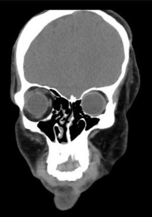 CT image depicting craniofacial asymmetry.