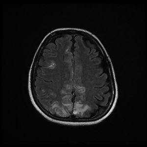 Magnetic resonance imaging (T2-weighted and FLAIR images): Axial slices showing hyperintense areas with bilateral cortical and subcortical white matter involvement, more extensive in the right hemisphere. Involvement is seen in the parasagittal region and bilateral parietal convexity, and in the bilateral frontal parasagittal region. The image is suggestive of PRES.