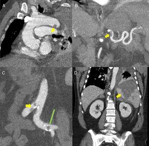 (A) Oblique multiplanar reconstruction (MPR) of contrast-enhanced chest computed tomography (CT) showing a filling defect measuring about 12mm in the distal portion of the aortic arch, suggestive of thrombosis (yellow arrow). (B) Coronal maximum intensity projection (MIP) reconstruction of contrast-enhanced abdominal CT, showing a filling defect in the proximal/middle portion of the splenic artery, suggestive of thrombosis (yellow arrow). (C) Coronal MIP reconstructions from contrast-enhanced abdominal CT showing filling defects in the aorta at the iliac bifurcation (yellow arrow) and in the left common iliac arteries (long green arrow). (D) MPR reconstruction of contrast-enhanced abdominal CT coronal slice showing a large triangular hypodense area in the spleen, consistent with splenic infarction (yellow arrow).