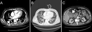 Chest-abdomen contrast-enhanced CT angiography. Image A shows a filling defect in the right main artery (arrow). Image B shows bilateral pulmonary infiltrates and uncomplicated acute cholecystitis (arrow in image C).