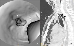 Neck and chest CT scan with 3D axial reconstruction of the trachea (A) and sagittal reconstruction of the upper thorax (lung window) (B) showing a defect in the posterior wall of the trachea (arrowhead in both images) associated with pneumomediastinum and marked subcutaneous emphysema (curved arrows). To help interpret the 3D reconstruction, straight arrows have been added in both images to indicate the posterior edge of the tracheostomy tube.