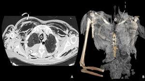 A: Axial chest CT image using a lung window showing tracheal rupture (black arrow head), pneumomediastinum and marked subcutaneous cellular emphysema (curved arrow). The right hemithorax shows high-density pleural effusion associated with haemothorax (white arrowhead), as well as patchy ground-glass opacities in the lung parenchyma associated with SARS-CoV-2 involvement (white straight arrow). B: 3D reconstruction of subcutaneous emphysema.