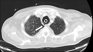 Axial chest CT image (lung window) performed 12 days after the new tracheostomy, in which persistence of the tear is observed in the upper third of the posterior tracheal wall, with the formation of a pseudodiverticulum (arrow) and resolution of pneumomediastinum and subcutaneous emphysema.