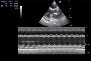 Parasternal longitudinal axis view showing biventricular dilation and small pericardial effusion.