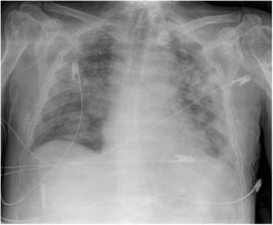 Plain chest X-ray (patient 5). Bilateral pulmonary opacities. Tracheostomy tube. Peripherally inserted central venous catheter.