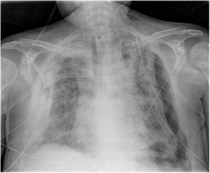 Plain chest X-ray (patient 5). Severe bilateral consolidation, bilateral pneumothorax, mediastinal widening, left jugular vein catheter, thoracic drains (both sides), subcutaneous emphysema, left hemithorax staples (due to thoracotomy, see text for further explanation).