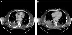 Computed tomography (patient 6). (a) Bilateral pulmonary condensations and some interstitial infiltration. (b) Bilateral pulmonary condensation and pleural effusion, especially in the left hemithorax.