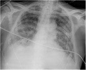 Plain chest X-ray (patient 6). Bilateral pulmonary opacities and consolidations. Right pleural effusion. Catheter in left internal jugular vein.