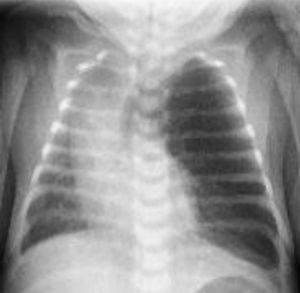 Chest X-ray: hyperinflation of the LUL with contralateral mediastinal shift.