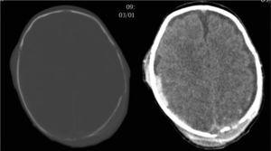 Multiple diastatic skull fractures, extensive right subdural haematoma, and subgaleal fluid collections in the left parietal region.
