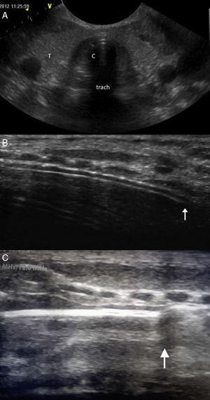 (A) Transverse plane: hyperechogenic shadowing or “comet tail” sign (C) visible in ET. (B) Longitudinal plane: double track echogenic line corresponding to the ETT (arrow) posterior to tracheal rings. (C) In cases of superior malposition, a posterior acoustic shadow corresponding to the air in the trachea can be visualised (arrow). T: thyroid; Trach: trachea.
