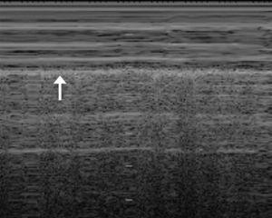 M-mode lung ultrasound: sliding lung sign; image resembling sand known as the “seashore sign”. Pleural line (arrow).