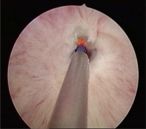 Stenosis of the membranous urethra in cystoscopy image and laser fulguration.