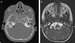 CT scan and MRI of petrous part. (a) Axial high resolution TC scan. (b) Axial CISS (three-dimensional constructive interference in steady state) MRI. Membranous labyrinth malformation affecting the right cochlea and vestibule (incomplete partition type ii, also known as Mondini dysplasia) (black arrows).