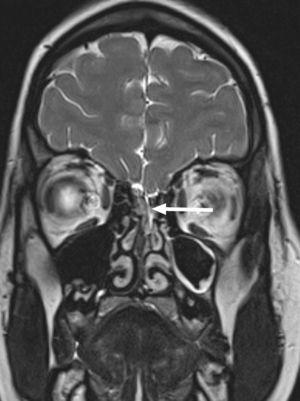 Coronal 3D CISS MRI of the frontonasal region showing a subtle osseous and dural defect at the level of the cribriform plate (white arrow) with a fistula extending towards the left nasal fossa.