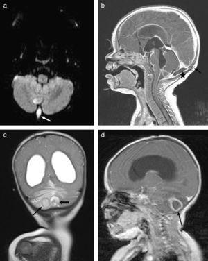 (a) Axial diffusion MRI showing an infected dermal sinus in the posterior fossa (white arrow) with restricted diffusion. (b) Post-contrast sagittal T1 MRI showing the subcutaneous dermal sinus tract (black arrow), complicated by a small subdural empyema in the posterior fossa (asterisk). (c) Coronal T2 MRI showing nonresorptive hydrocephalus secondary to leptomeningitis and 2 patterns compatible with cerebellar abscesses associated with oedema. (d) Post-contrast sagittal T1 MRI showing hydrocephalus and ring enhancement in intraparenchymal cerebellar abscesses (black arrow).