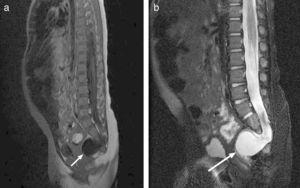 Currarino syndrome. (a) Sagittal T1 MRI. b) T2 image showing partial agenesis of the right side of the sacrum starting at S3, with presacral meningocele below S2 (white arrow).