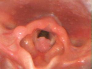 Fibre-optic laryngoscopy: lesion of papillomatous appearance, occupying the anterior third of the vocal cords and partially obstructing the glottic lumen.
