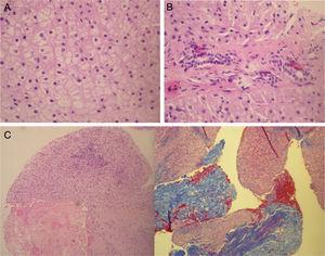 Histology of focal nodular hyperplasia of the liver. Liver biopsy corresponding to a case of FNH: (A) normal cellularity without atypia. (B) Absence of portal triads (characteristic of FNH). Presence of bile canaliculi (inconsistent with hepatic adenoma). (C) Presence of fibrosis (Masson's trichrome stain).