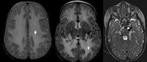 Transversal T2-weighted images showing extensive involvement of the periventricular, deep and cerebellar white matter (white asterisks). Involvement of the corpus callosum (black asterisks) and the corticospinal tract, from the posterior limb of the internal capsule and pyramidal tracts in the brainstem (black arrows). Abnormal signal intensity in the thalamus and medial lemniscus in the brainstem (white arrows). Trigeminal nerve trajectory involvement (white arrow head).