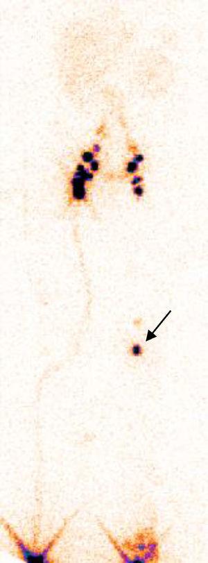 Lymphoscintigraphy image (anterior view) showing delayed lymph drainage in the left lower extremity, with persisting radioactive tracer activity at the level of the popliteal lymph nodes (arrow), compatible with primary lymphoedema.