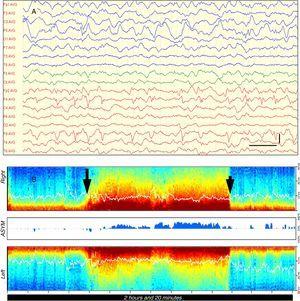 Case 1 (A) EEG showing frequent focal epileptiform discharges involving the entire right frontal lobe (Fp2, F4, F8) and increased slow waves in the left temporo-occipital region; low-frequency filter: 0.53Hz; high-frequency filter: 30Hz; notch filter: 50Hz. Vertical bar: 100μV, horizontal bar: 1s; (B) DSA showing an abrupt change in colour (long arrow) from orange, yellow and green tones to dark red tones in the low-frequency band (<10Hz), suggestive of recurrent epileptic activity. After a little over one hour, the DSA returned to its previous features concurrently with the administration of thiopental (short arrow). The white line in the DSA represents the spectral edge frequency (SEF), which is the frequency in Hertz below which 95% of the power of the brain resides. (In the black and white printout, the dark red in the low-frequency band appears as dark grey tones that are nearly black.)
