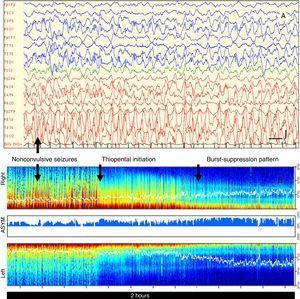 Case 2 (A) EEG with evidence of bilateral epileptiform discharges with spike-and-wave complexes between 2 and 3Hz and up to 300μV in amplitude, with maximum amplitude in the temporal lobe and parieto-occipital regions of the right hemisphere (F8, T4, T6, O2). Low-frequency filter: 0.53Hz; high-frequency filter: 30Hz; notch filter: 50Hz. Vertical bar: 200μV, horizontal bar: 1s; (B) DSA initially characterised by a dark red spike pattern with predominance of the right hemisphere due to the high amplitude of the epileptic discharges on this side. Following initiation of IV thiopental, the DSA shows a progressive change until blue tones become predominant, which indicates a drop in brain wave amplitude consistent with a burst-suppression pattern. (In the black and white printout, the dark red in the low-frequency band appears as dark grey tones that are nearly black. Following initiation of thiopental, these tones lighten progressively under the white line [SEF] until they disappear.)