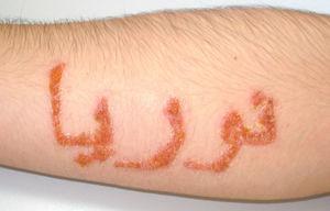 Allergic contact dermatitis caused by PPD from a black henna tattoo in an adolescent aged 16 years. The patient developed a vesicular rash with scab formation delineating the application of henna for the tattoo.