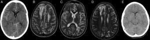 Patient 1 (A–D). Simple axial CT scan with sulcus hyperdensity suggestive of subarachnoid haemorrhage in the right lateral sulcus, superolateral sulci with right-side predominance, and the left peripeduncular cistern (A). T2 TSE axial MRI at day +27 with evidence of bilateral frontal cortical and subcortical lesions and bilateral frontal and left parietal deep white matter lesions compatible with ciclosporin toxicity (B and C). T2 TSE axial MRI at six months post HSCT with evidence of residual lesions (D). Patient 9 (E): axial head CT scan with hyperdensity in left frontotemporal sulci as evidence of subarachnoid haemorrhage on day +2.