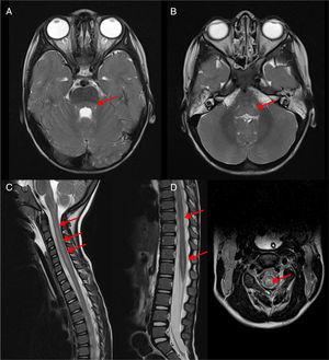 Rhombencephalitis caused by EV-D68: T2-weighted brain and spinal cord MRI scans obtained during the acute phase of disease. The arrows point at dorsal involvement at the level of the pontine (A) and bulbar tegmentum (B) as well as the entire medulla oblongata (C) with grey matter predominance (D) (Courtesy of Ignacio Delgado, Radiology Dept.).