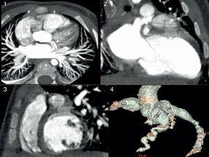 Cardiac CT scan. The proximal giant-sized aneurysmal dilatation in the LAD and RCA can be seen in the three views of the multiplanar reconstruction: axial (image 1), coronal (image 2), and sagittal (image 3); the 3D reconstruction (image 4) accurately shows the location, extension and size of the aneurysms. Localisation of hypoperfusion in the inferior wall, necrosis and lack of viability in one segment (image 1) and hypoperfusion without signs of myocardial injury in the LAD region (image 2).