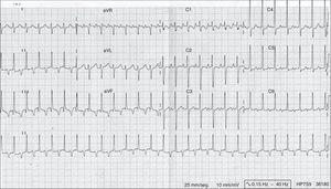 Electrocardiograph showing features of junctional atrioventricular reciprocating tachycardia. Regular tachycardia with narrow QRS complex, long RP interval (RP>PR) and a negative P-wave in the inferior leads (II, III and aVF).