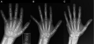 (A) Röntgenbild av den vänstra handen hos proband (kronologisk ålder, 7 år; benålder, 5 år), med förkortning av en avvikande första metacarpal (dubbla proximala och distala epifysplattor) och mellanfalangerna i andra, tredje och femte fingret. Andra fingret uppvisar ulnaravvikelse, och fjärde fingret är minst påverkat och längst i vänster hand. De proximala epifyserna i andra och tredje fingret är dysplastiska, med en iögonfallande ängelformad mittfals i andra fingret (infälld i A). (B). Röntgenbild av den vänstra handen hos probandens syster (5½ år gammal utan fördröjning av benåldern), med förkortning av andra, tredje och femte fingrets mittfingertoppar och ett normalt fjärde finger. I detta fall var den första mellanhanden normal. Det mest framträdande kännetecknet är den triangulära formen på den proximala epifysen på andra fingrets proximala falang, som liknar broderns, och den trapetsformiga formen på falangen i mittfingret. Liksom hennes bror uppvisar hennes andra finger ulnardeviation. (C) Röntgenbild av vänster hand hos probandens far, som endast visar en benig rest av en postaxial hexadaktyli som korrigerades kirurgiskt i barndomen.