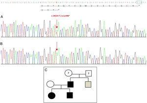 Nova mutação detectada no gene GDF5. (A) Seqüência gênica do exon 2 na probanda, mostrando uma mutação c.1462AT que resulta em um códon de parada prematura e uma proteína truncada (p.Lys488*) (indicamos a posição normal do códon de parada com um quadrado verde). (B) Sequência normal da mesma região na mãe saudável. (C) Pedigree da família: o pai e ambos os filhos, em preto, têm uma mutação confirmada em GDF5. A mãe saudável aparece em branco. O quadrado cinza representa um tio paterno com polidactilia bilateral pós-axial que provavelmente tem a mutação.