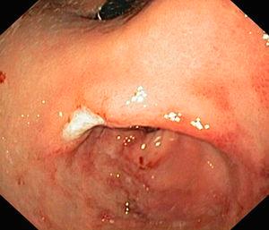 Oedema and erosion of gastric mucosa with pyloric stenosis and ulcer in the angular notch.