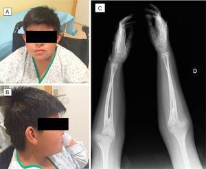 (A and B) Frontal and lateral view of the patient. (C) Forearm A-ray revealing radioulnar synostosis.