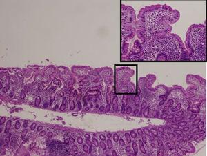 Duodenal mucosa with villous atrophy.