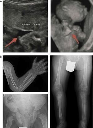 Characteristic findings of imaging tests in cases of perinatal lethal hypophosphatasia (a) and infantile hypophosphatasia (b). (a) Ultrasound at 18 weeks’ gestation: bone spurs in right knew and right elbow (3D). (b) Radiologic evaluation in patient aged 17 months: marked changes in long bone methaphyses (proximal metaphyses of both humeri, distal metaphyses of both radii and ulnae, and proximal metaphyses of both femora, tibiae and fibulae), with metaphyseal flaring, reduced bone density, thickened trabeculae and radiolucent projections that extend from physis to metaphysis. Linear periosteal reaction in the left radius. Images reproduced with the authorization of Zankl A, Mornet E, Wong S. Specific ultrasonography features of perinatal lethal hypophosphatasia. Am J Med Gen Part A. 2008;146A:1200–1204, and Caballero Mora FJ, Martos Moreno GA, García Esparza E, Argente J. Hipofosfatasia infantil. An Pediatr. 2012;76:368–369.