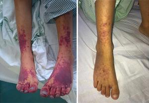 (a) Purpuric lesions in distal region of lower extremities following diagnosis of haemophagocytic syndrome; (b) change in purpuric lesions after treatment of intravenous methylprednisolone and nitroglycerine patches.