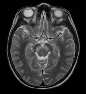 Case 2 patient: T2-weighted hyperintensity at mesencephalon.