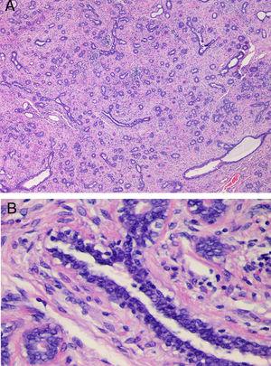 (A) Histological examination in case 3. Fibroepithelial proliferation with areas of pericanalicular and intracanalicular growth. No evidence of marked stromal growth, fat infiltration or cleft-like spaces. (B) Detail of Fig. 2A (H&E stain, 4×), showing a mildly hyperplastic epithelium and a stroma without cytological atypia or mitotic activity.