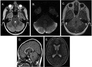 fej MRI. (A) T2-súlyozott axiális sík: hiperintenzitás és duzzanat mindkét kisagyi féltekén. B) Általános korlátozott diffúzió. C) T1-súlyozott axiális nézet: a gadolínium kontraszt beadása után a javulás hiánya. (D) T1-súlyozott sagittalis nézet: a cerebelláris mandulák leereszkedése a foramen magnumba, az agytörzs elülső elmozdulása és az agyi vízvezeték és a negyedik kamra enyhe caudalis összenyomódása. (E) másodlagos supratentorialis kamrai dilatáció.