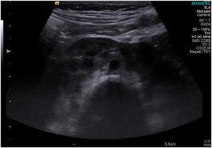 Renal ultrasound image showing horseshoe kidney with isthmus in the midline of the retroperitoneal space.