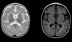 Diffuse und lückenhafte Signalanomalien in der weißen Substanz in beiden Gehirnhälften, hyperintensiv in T2-gewichteten Bildern. Vergrößerter Subarachnoidalraum mit frontotemporaler Dominanz in beiden Hemisphären, mit Erweiterung der interhemisphärischen Fissur und erhöhter ventrikulärer Größe (ohne erhöhten Druck), kompatibel mit kortikaler und subkortikaler Atrophie.