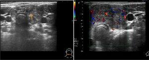 Patient 1. Ultrasound findings indicative of malignancy: solid nodule in left lobe and isthmus of the thyroid (0.18×0.37×0.4mm), heterogeneous, hypoechoic, with poorly defined margins and microcalcifications. Doppler ultrasound scan revealing increased intranodular blood flow.