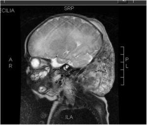 MRI. Heterogeneous hyperintense lesion on T2-weighted image.
