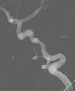 Percutaneous coil embolization of vein of Galen aneurysmal malformation.