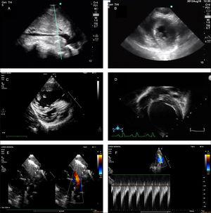 Point-of-care ultrasound images corresponding to different clinical situations. (A) Inspiratory collapse of inferior vena cava, subcostal view. Sign indicative of hypovolemia in the context of compatible clinical manifestations. (B) Left ventricular systolic collapse, parasternal short axis view. Sign suggestive of hypovolemia in the context of compatible clinical manifestations. (C) Image compatible with dilatation of right ventricle and septal flattening suggestive of pulmonary hypertension. (D) Image showing dilatation of left ventricle in the context of haemodynamic instability, suggestive of severe ventricular dysfunction. (E) Large patent ductus arteriosus in preterm infant. (F) Doppler image at the level of the left pulmonary artery showing an increased end diastolic flow velocity, suggestive of increased pulmonary blood flow and haemodynamically significant patent ductus arteriosus.