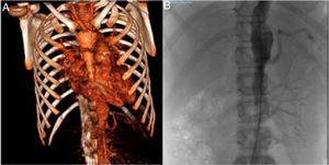 (A) Computed tomography angiogram. Stenosis of left subclavian and vertebral arteries, abdominal aorta and right renal arteries. (B) Arteriogram of the aorta. Right kidney with renal artery bifurcation and critical stenosis in the ostium, and left kidney with no signs of stenosis of the renal artery.