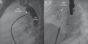 (a) Right anterior oblique angiogram showing the Occlutech PDA occluder (arrow). The contrast infused from the descending aorta evinces the absence of a residual shunt through the patent ductus arteriosus. AO DESC: descending aorta. (b) Anteroposterior fluoroscopy view that shows the ASD closure device, the Figulla ASD Occluder (arrow), after its release.
